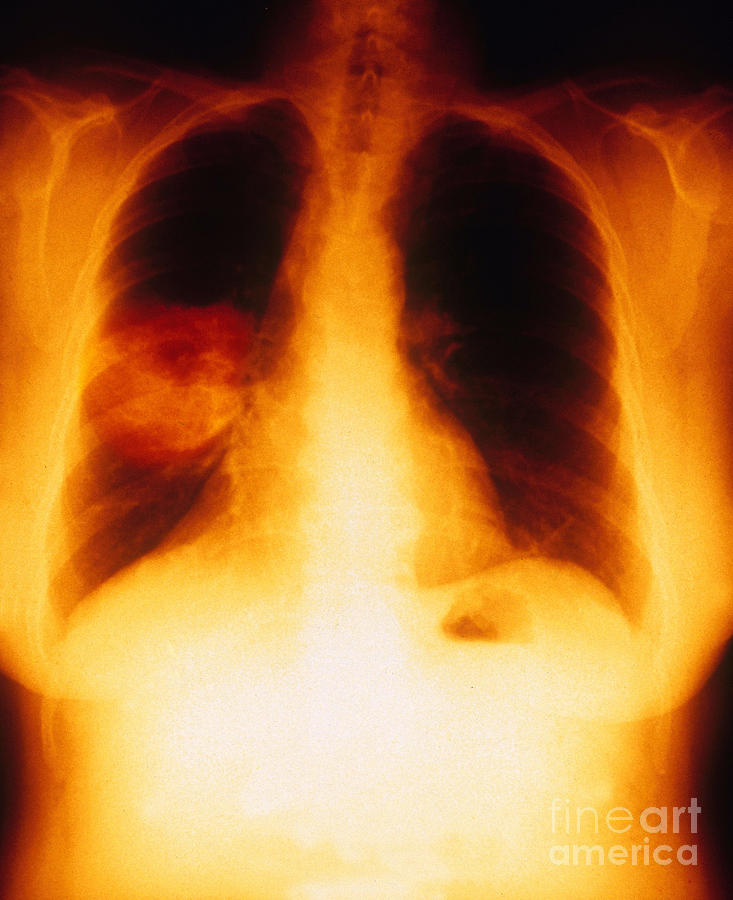 Medical Photograph - Squamous Cell Carcinoma, Lungs, X-ray #1 by Scott Camazine
