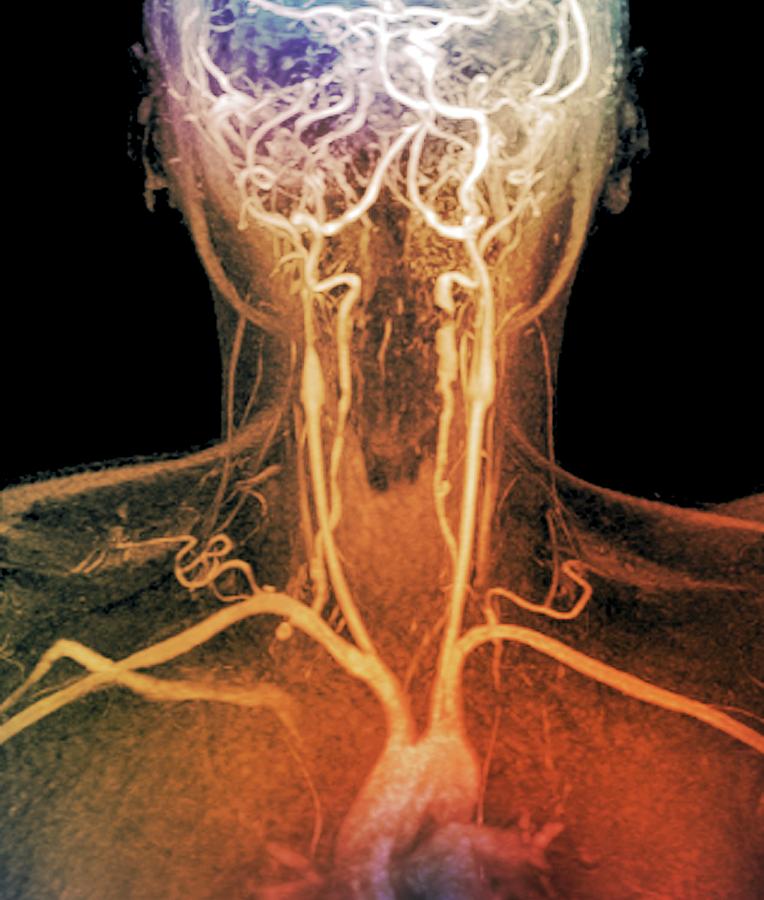 Stenoses In Neck Arteries Photograph by Zephyr/science ...