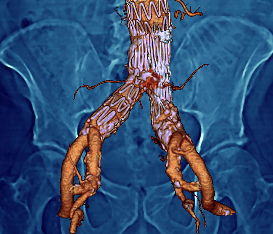 Stent In The Abdominal Aorta Photograph By Zephyr/science Photo Library ...