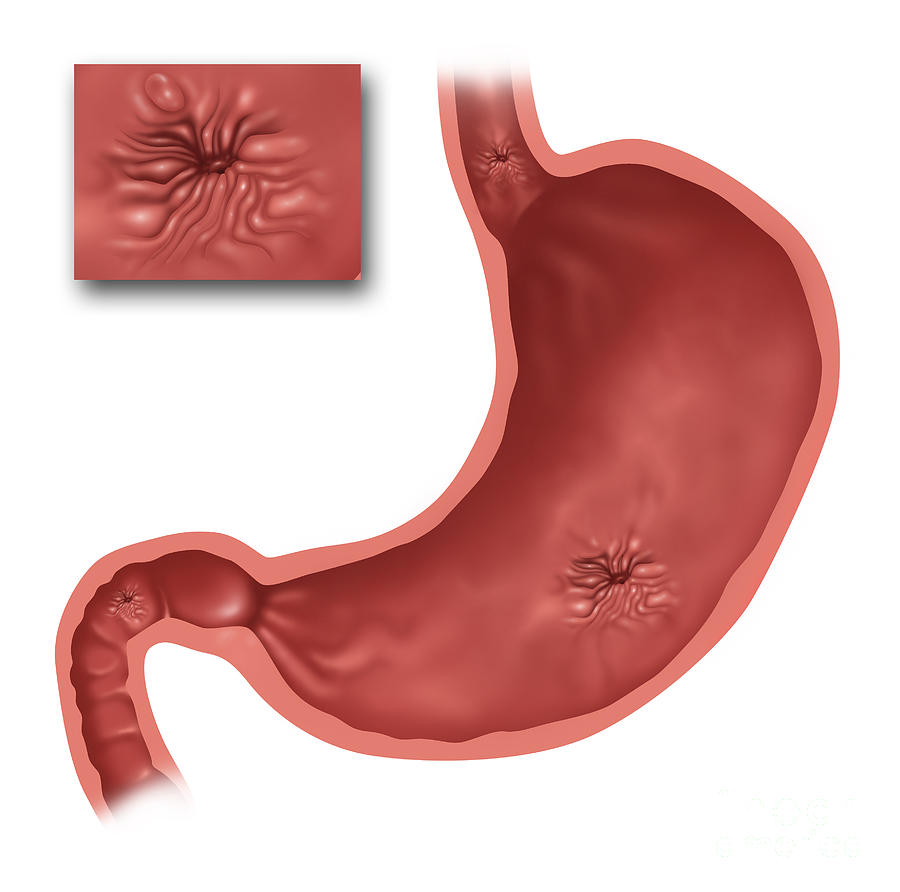 Illustration Photograph - Stomach Ulcers, Illustration #1 by Gwen Shockey