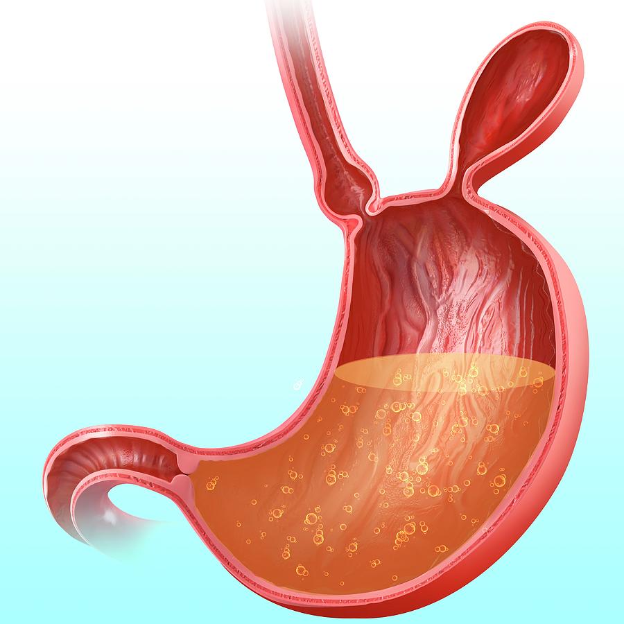 Stomach With Hernia Photograph By Pixologicstudio Pixels