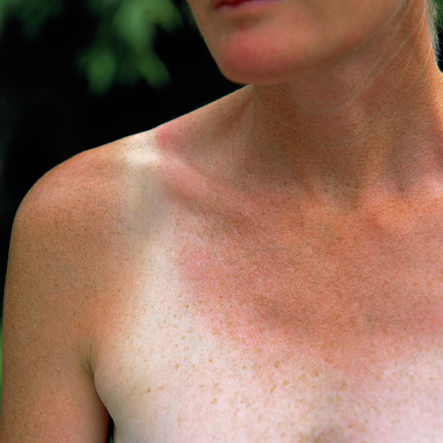Sunburnt Skin #1 Photograph by Sheila Terry/science Photo Library