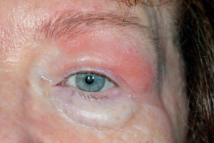 Swollen Eyelid Photograph by Dr P. Marazzi/science Photo Library