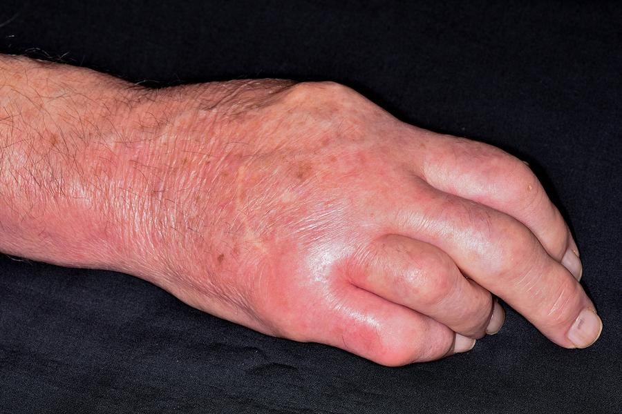 Swollen Hand In Gout Photograph by Dr P. Marazzi/science Photo Library