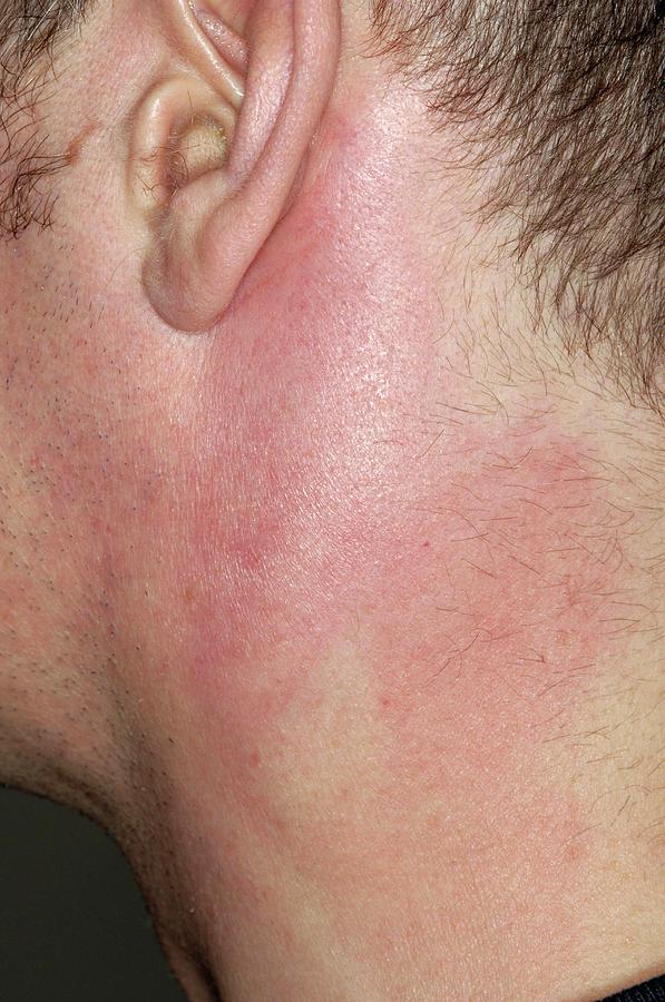 swollen lymph nodes in neck