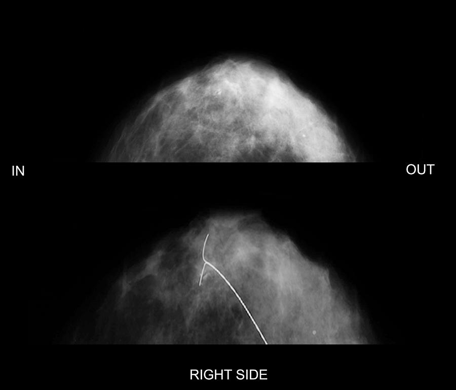 Black And White Photograph - Targeted breast surgery, mammogram #1 by Science Photo Library