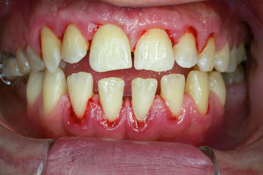 Teeth After Cleaning Photograph by Dr Armen Taranyan / Science Photo ...