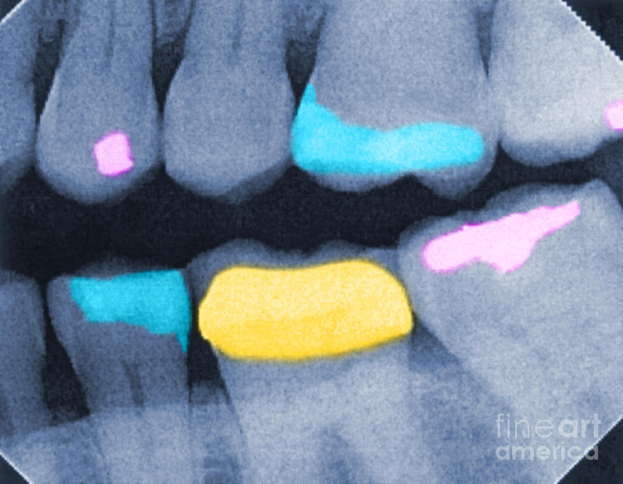 Teeth X-ray #2 Photograph by Spencer Sutton