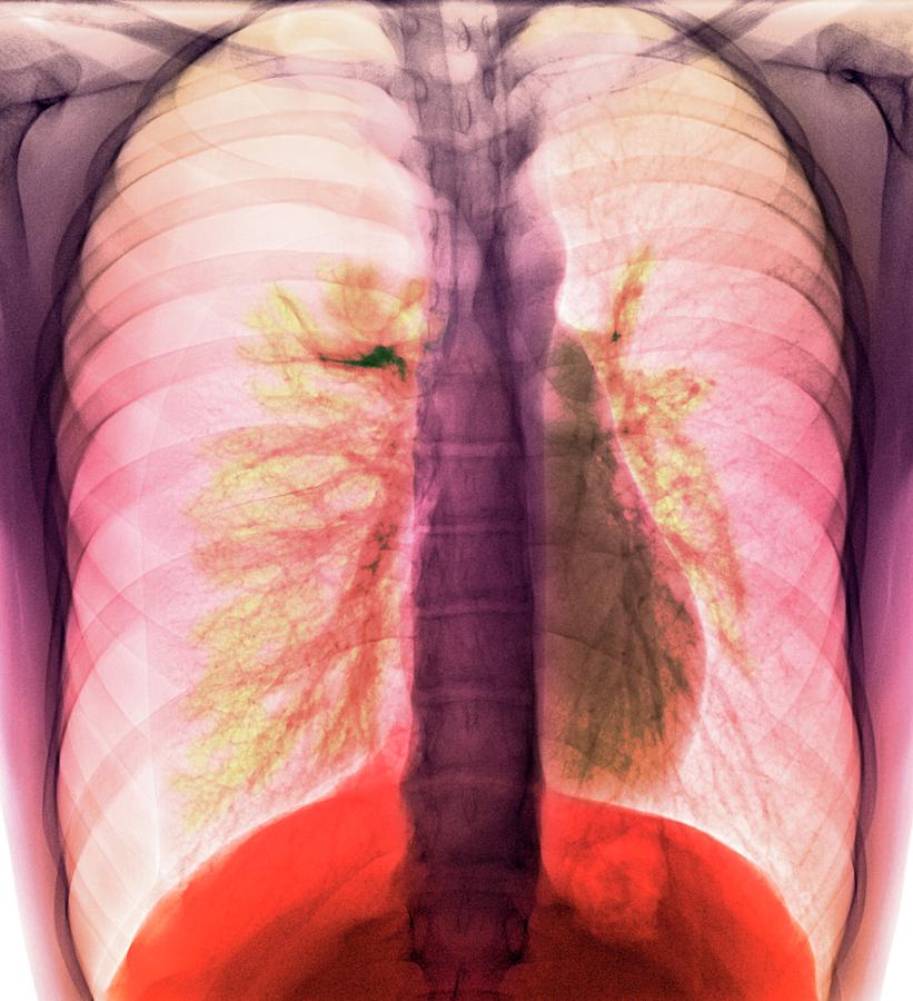 Tension Pneumothorax #1 Photograph by Science Photo Library Tension Pneumothorax #1 Photograph by Science Photo Library