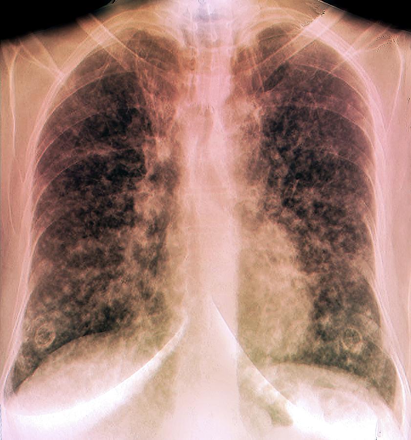 Disease Photograph - Terminal Lung Cancer #1 by Zephyr/science Photo Library