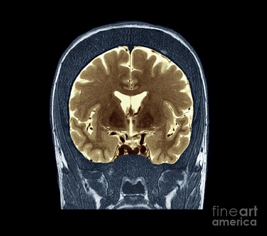 Thickened Skull Mri Scan Photograph By Zephyr Pixels