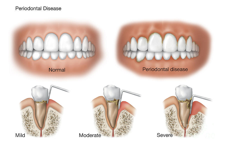 Three Stages Of Periodontal Disease #1 Digital Art by TriFocal Communications