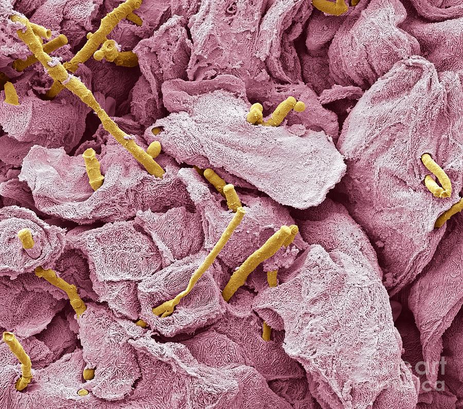 Abnormal Photograph - Thrush Infection Of The Tongue, Sem #1 by Steve Gschmeissner