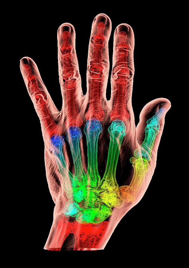 Thumb Fracture Photograph by K H Fung/science Photo Library - Fine Art ...