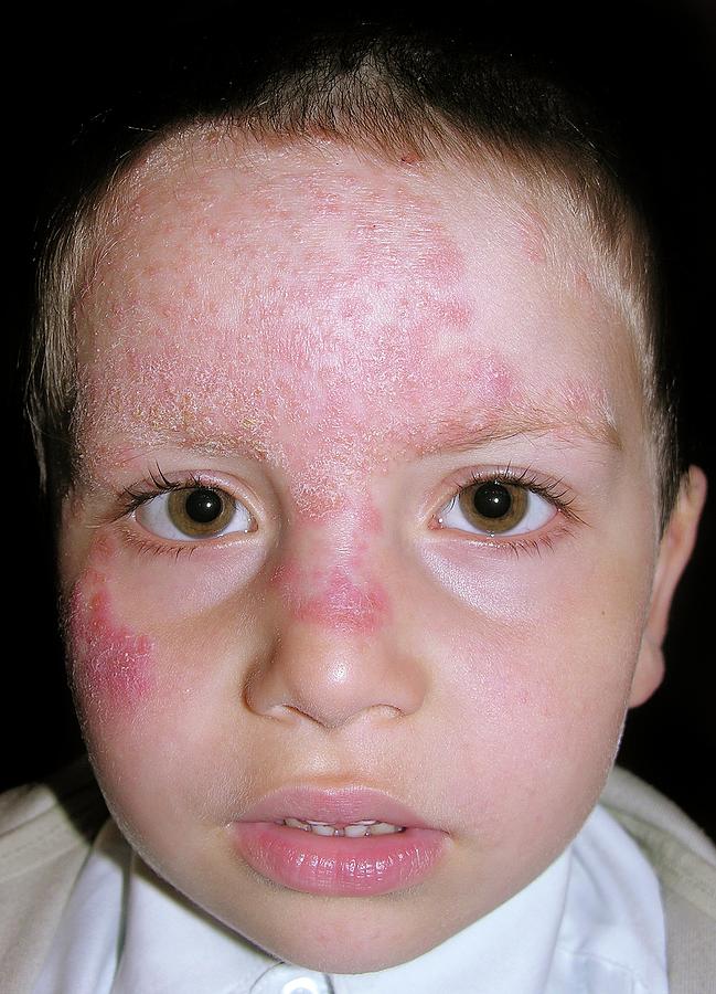 Tinea Fungal Infection On The Face Photograph By Dr Harout Tanielian 