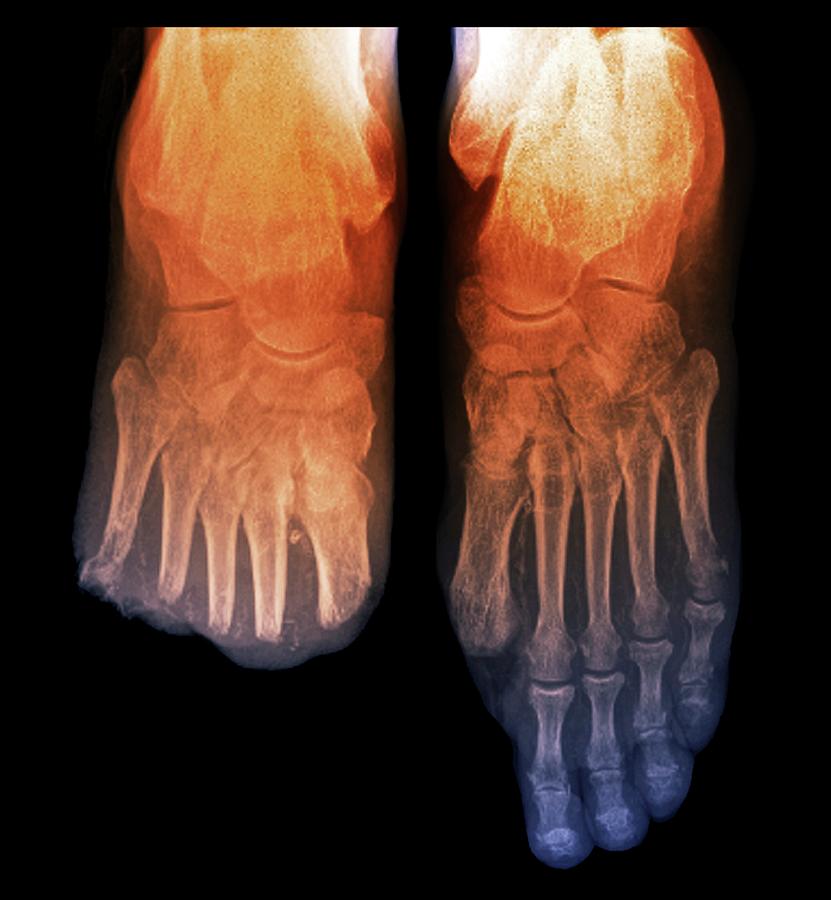 Toe Amputations In Diabetes #1 Photograph by Zephyr/science Photo Library