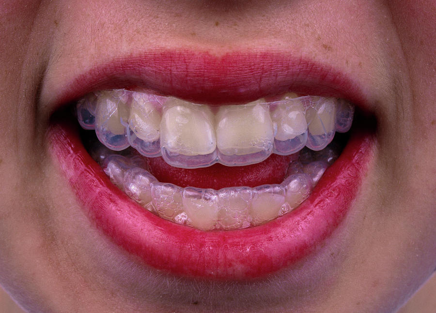 Tooth Brace #1 Photograph by Alex Bartel/science Photo Library