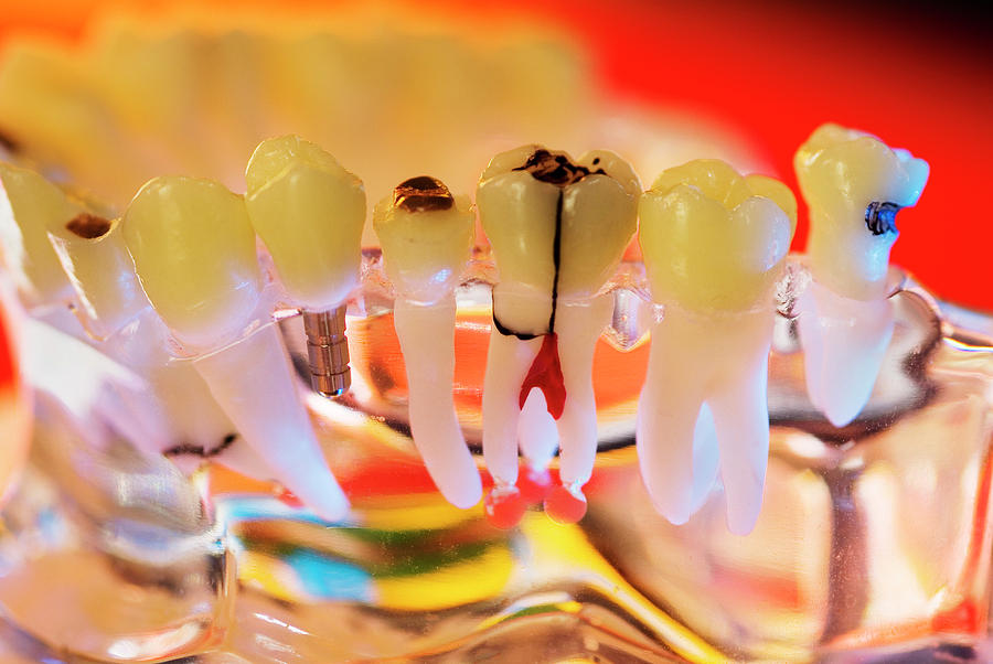 Tooth Decay And Implants #1 Photograph by Chris Knapton/science Photo Library