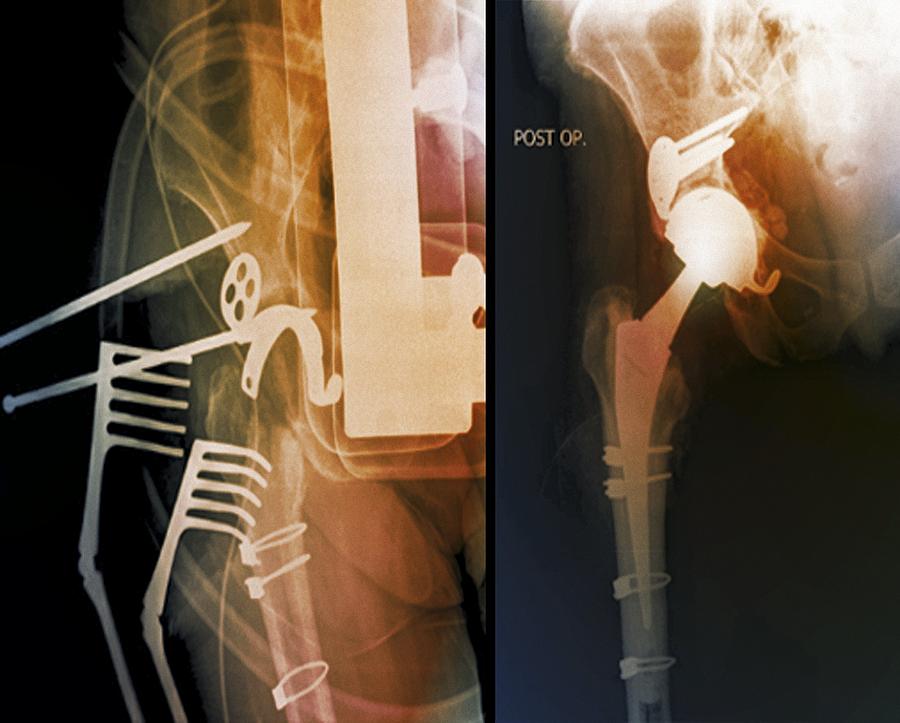 Total Hip Replacement X Rays Photograph By Science Photo Library Pixels
