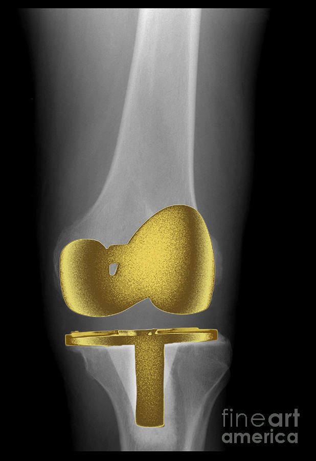 X-ray Photograph - Total Knee Replacement #1 by Living Art Enterprises