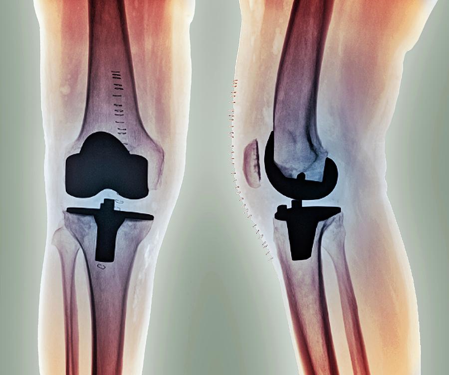 Radiological Photograph - Total Knee Replacement #1 by Zephyr/science Photo Library