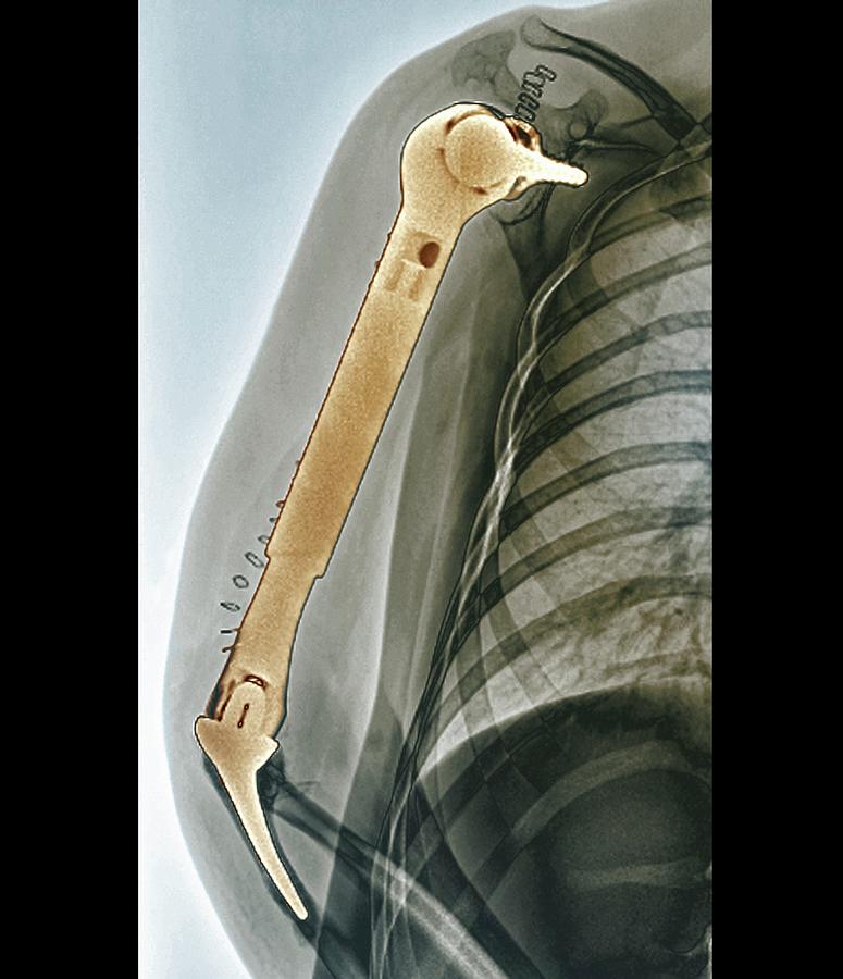 Total Upper Arm Bone Replacement Photograph by Zephyr