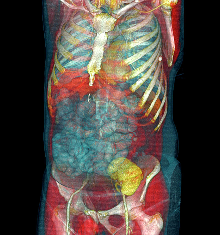 Kidney Photograph - Transplanted Kidney #1 by Antoine Rosset/science Photo Library
