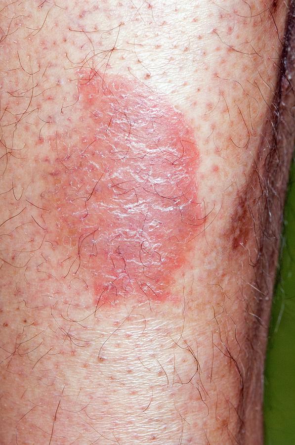 Treated Psoriasis On The Leg Photograph by Dr P. Marazzi/science Photo ...