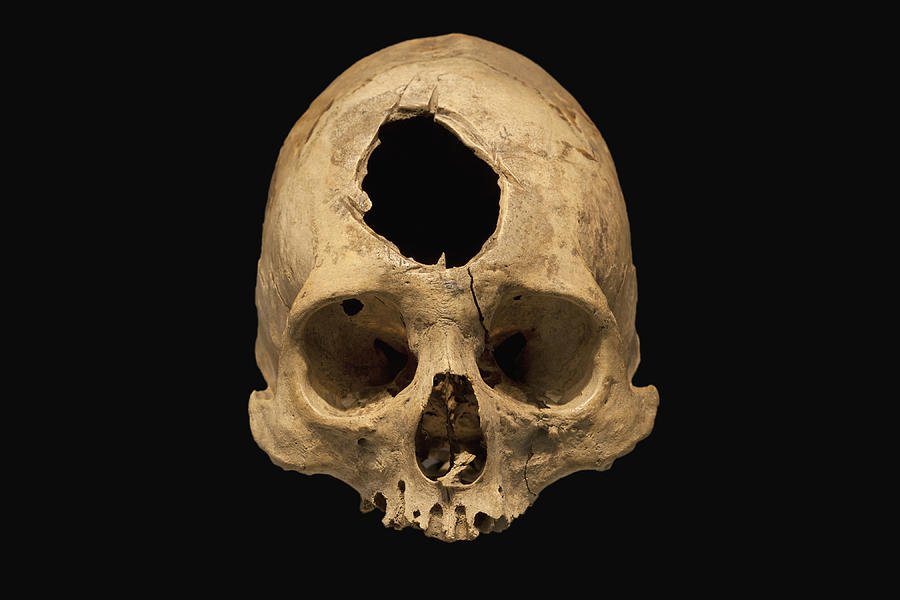 Trepanation #1 Photograph by Science Stock Photography