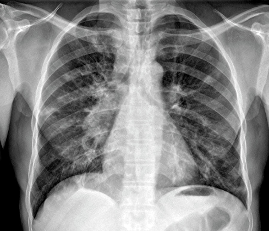 Tuberculosis Photograph - Tuberculosis Pneumonia #1 by Zephyr/science Photo Library