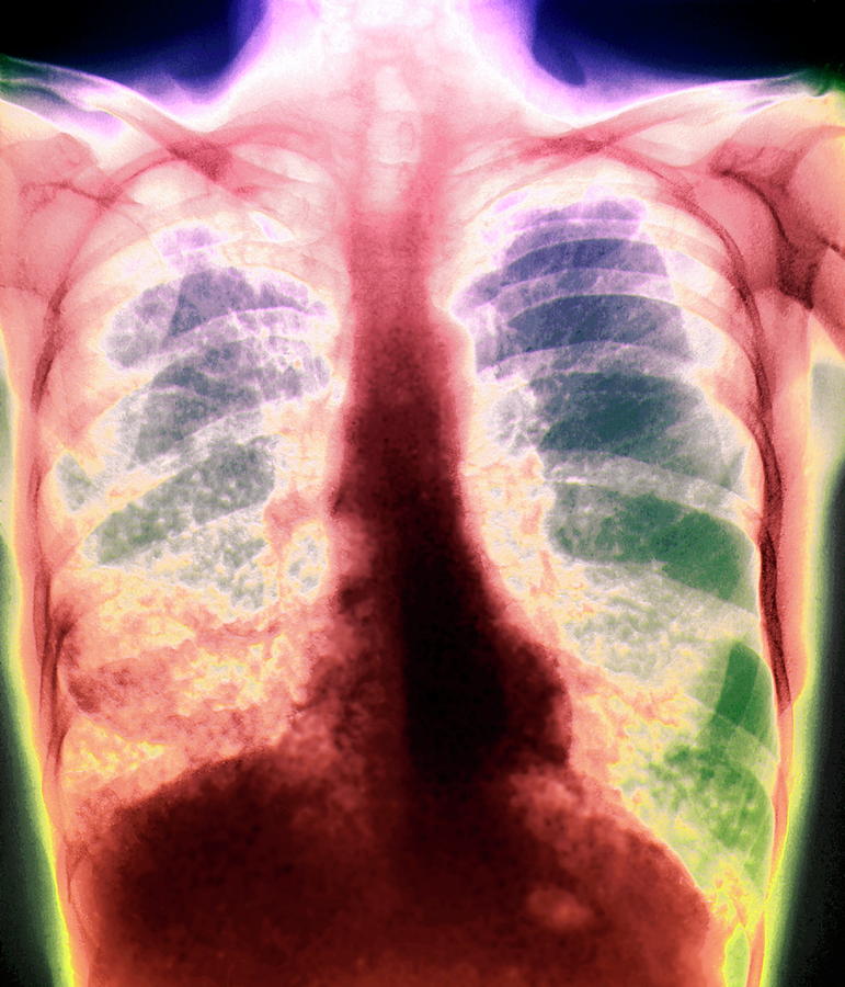 Tuberculosis Photograph by Zephyr/science Photo Library | Fine Art America