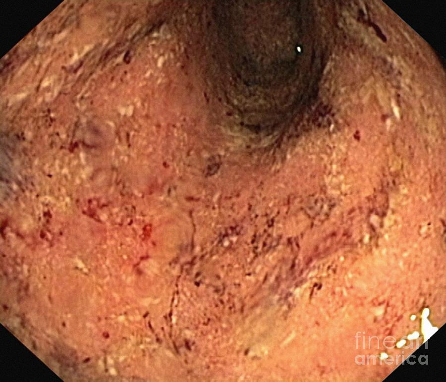Digestive System Photograph - Ulcerative Colitis, Endoscopic View #1 by Gastrolab