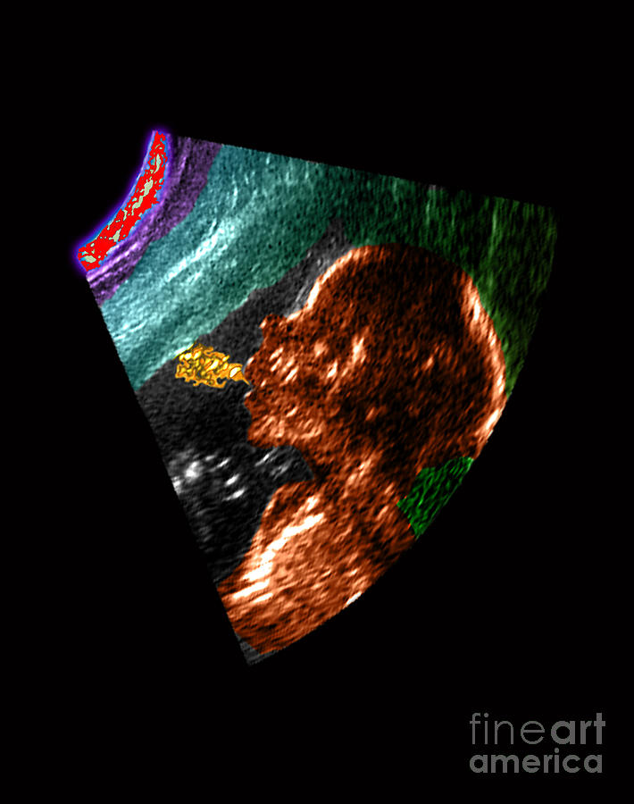 Obstetrical Ultrasound Photograph - Ultrasound Of Fetus Blowing Bubbles #1 by Living Art Enterprises, LLC