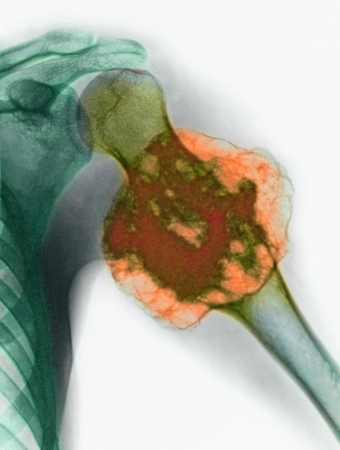 Upper Arm Tumour Photograph by Cnri/science Photo Library - Pixels