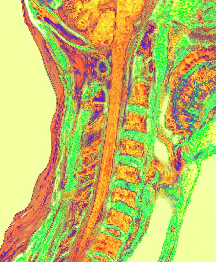 Upper Spinal Cord And Vertebrae #1 Photograph by K H Fung/science Photo Library