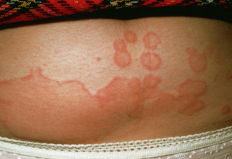 Urticaria Rash Photograph By Cnri Science Photo Library Pixels