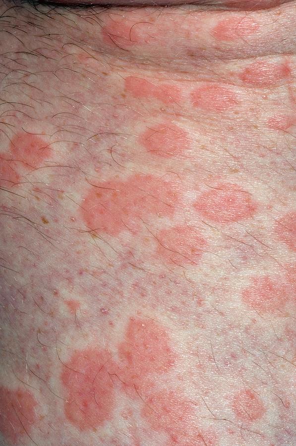 Urticaria Rash On The Skin Photograph By Dr P Marazzi Science Photo Library