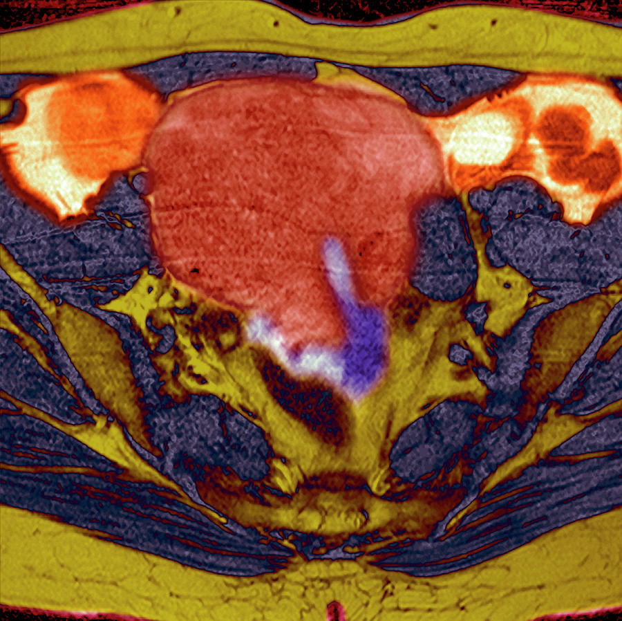 Uterine Fibroid Photograph by Simon Fraser/newcastle Hospitals Nhs ...