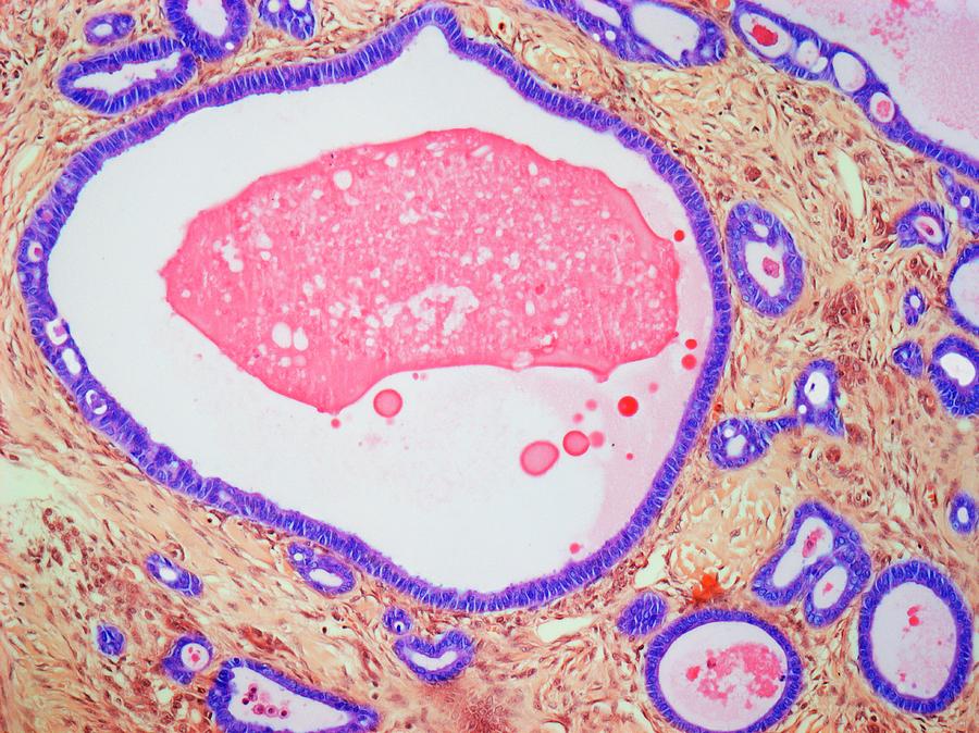 Histopathology Photograph - Uterus Adenofibroma #1 by Steve Gschmeissner