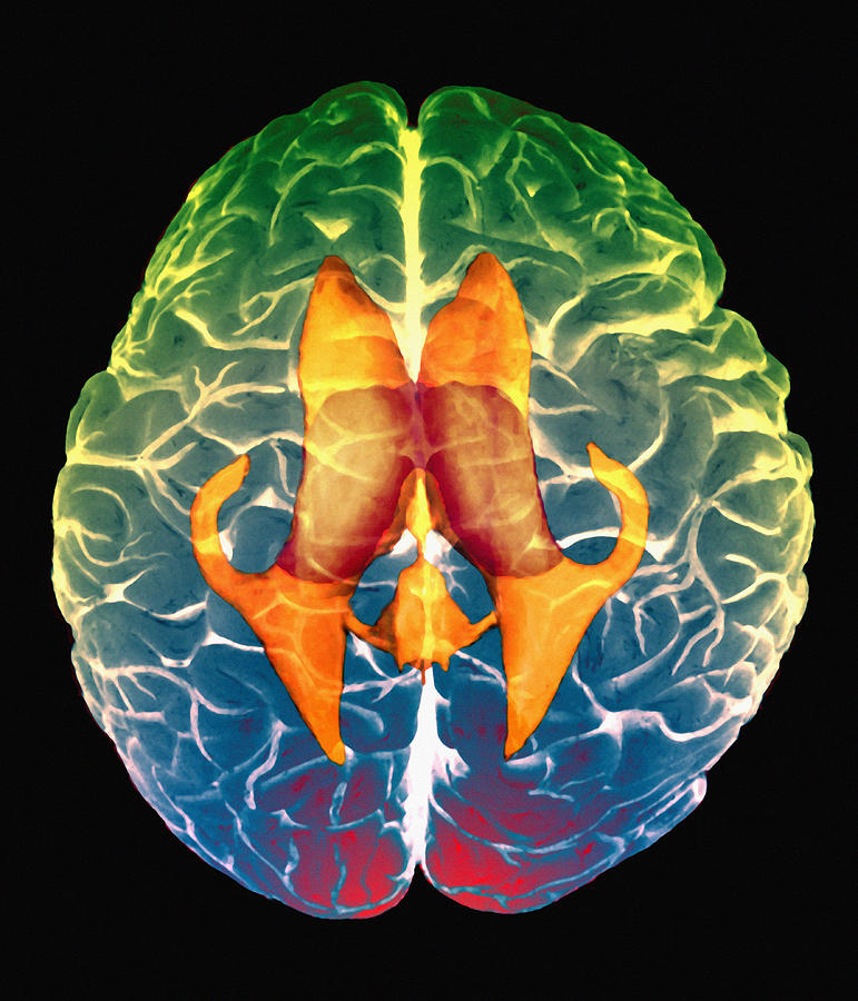 Ventricles Of Brain #1 Photograph by Zephyr/science Photo Library
