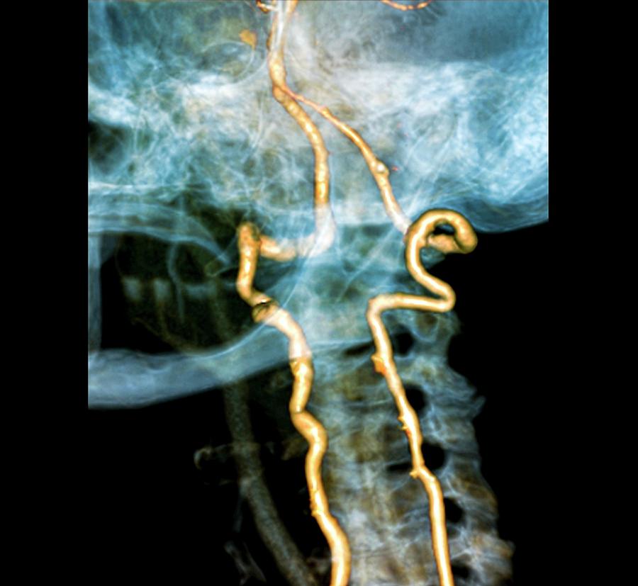 Vertebral Artery Insufficiency Photograph By Zephyr Fine Art America