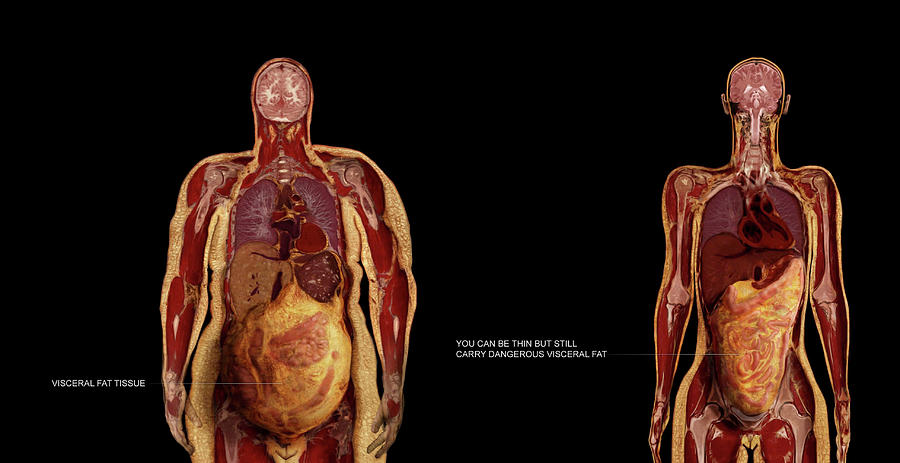 Visceral Fat Photograph By Anatomical Travelogue Fine Art America