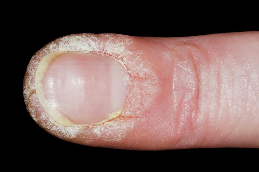 do finger warts itch