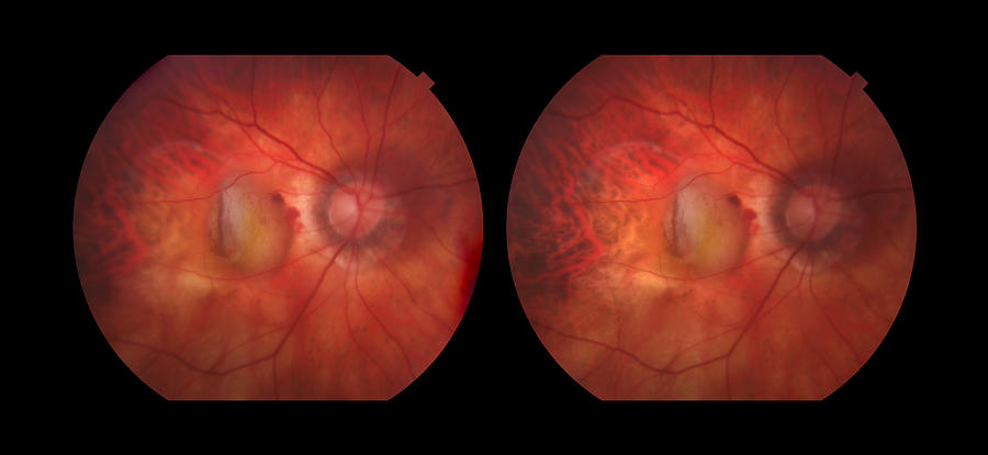 Wet Age-related Macular Degeneration Photograph By Paul Whitten