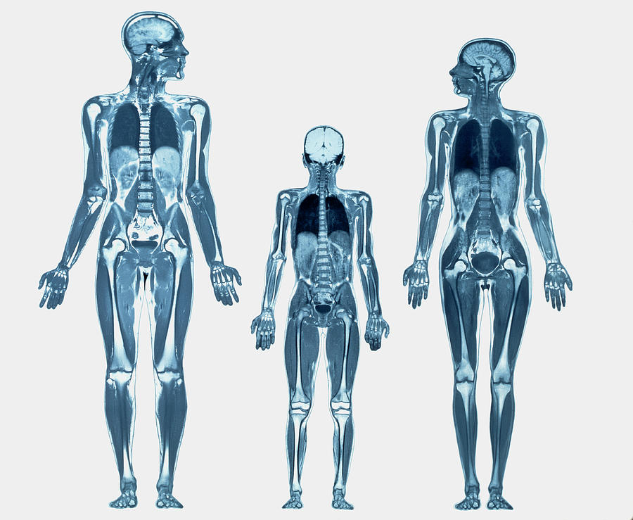 Whole Body Scans #1 Photograph by Simon Fraser/science Photo Library