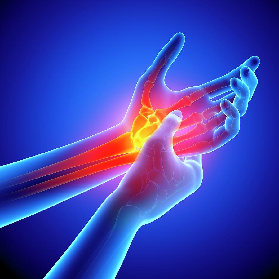 Wrist Pain Photograph by Pixologicstudio/science Photo Library - Fine ...