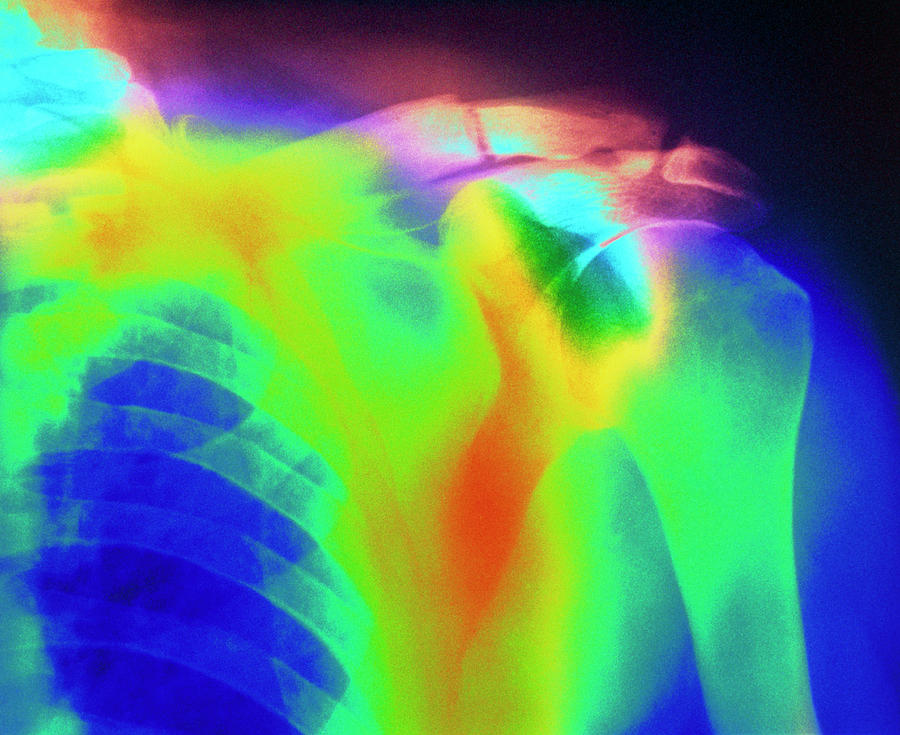 X-ray Of A Fractured Clavicle In Paget's Disease #1 by Mehau Kulyk ...