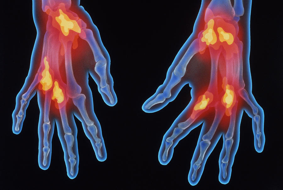 X-ray Of Arthritic Hands #1 Photograph by Chris Bjornberg