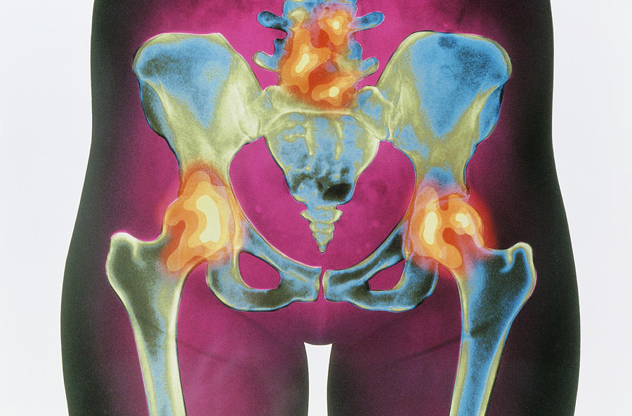 X-ray Of Arthritic Hips #1 Photograph by Chris Bjornberg