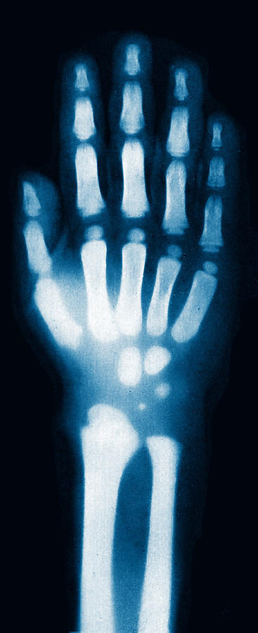 X-ray Of Childs Hand, 1896 #1 Photograph by Science Source
